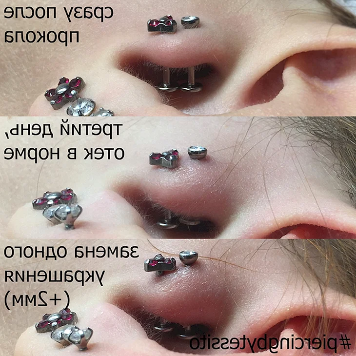 Этапы заживления пирсинга
