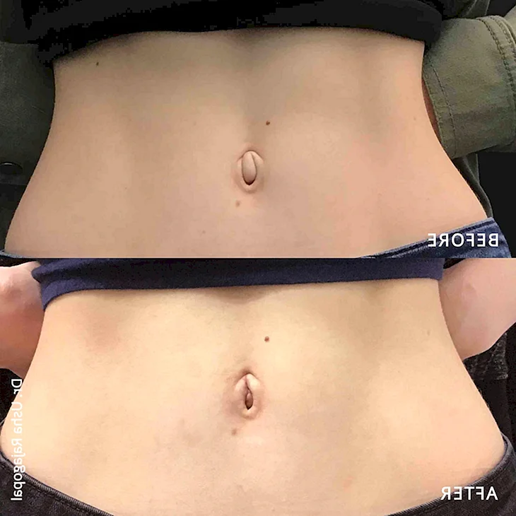 Outie belly button Ивана Петрова